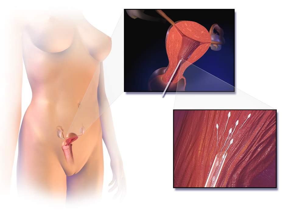 Artificial insemination: Pregnancy through in vivo fertilization