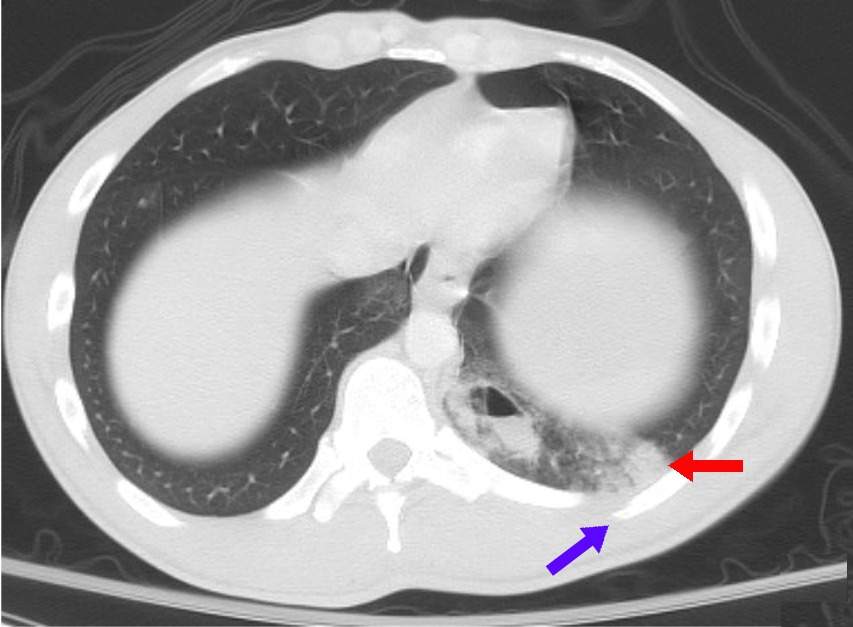 Asymptomatic: Patient is a carrier for a disease or infection but experiences no symptoms