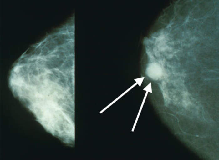 Breast cancer: Cancer that originates in the mammary gland