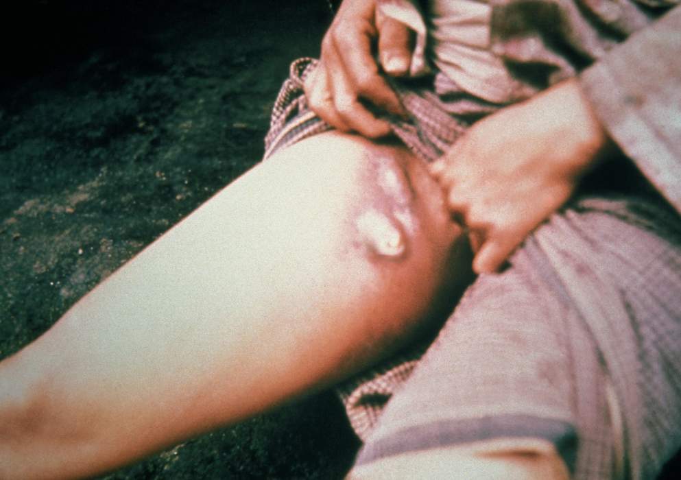Bubonic plague: Human and animal disease