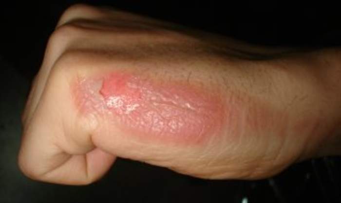 Burn: Injury to flesh or skin, often caused by excessive heat