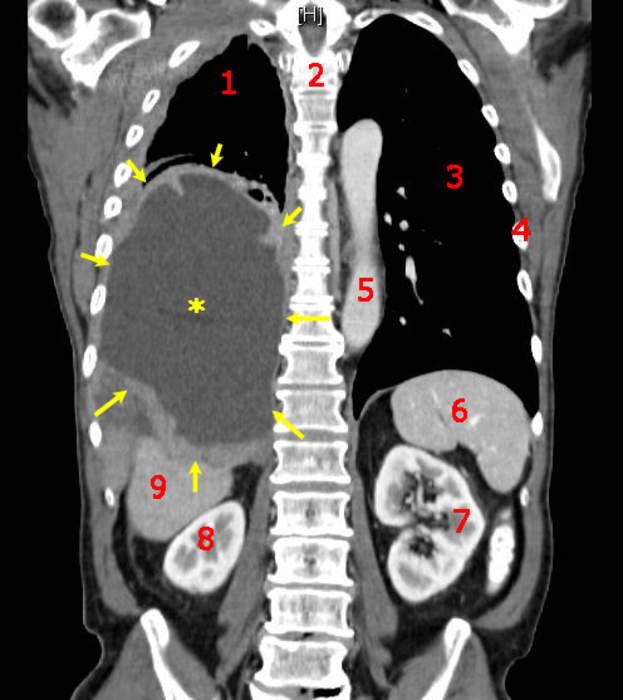 Cancer: Group of diseases involving abnormal cell growth and spread