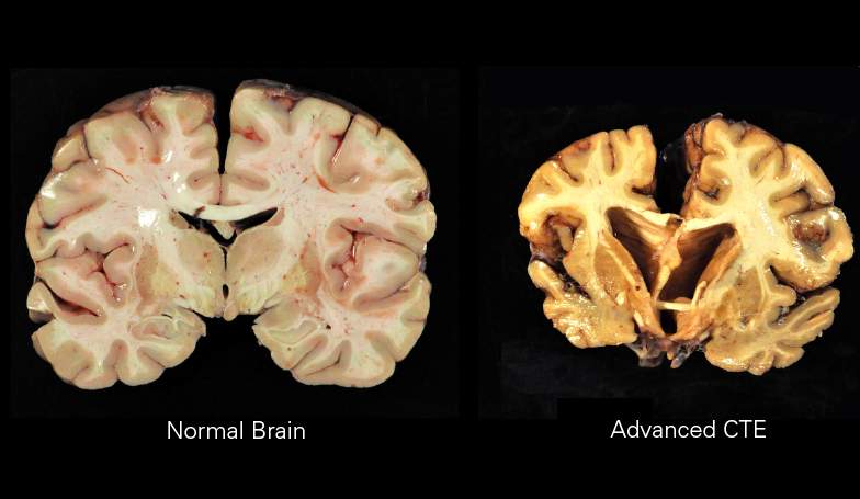 Chronic traumatic encephalopathy: Neurodegenerative disease caused by head injury