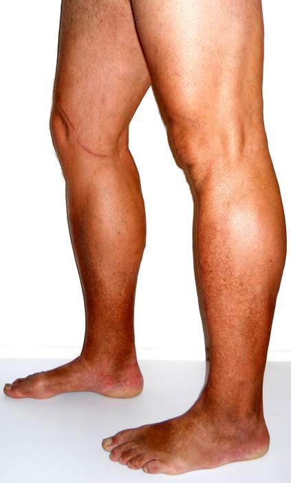Chronic venous insufficiency: Pooling of blood in the veins