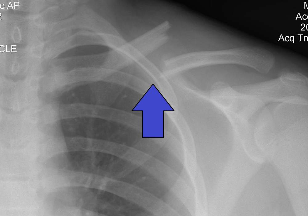 Clavicle fracture: Medical condition