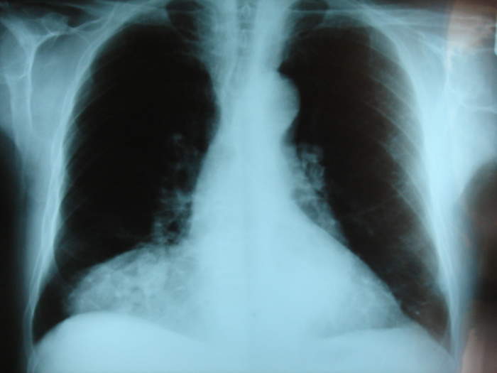 Congenital diaphragmatic hernia: Medical condition