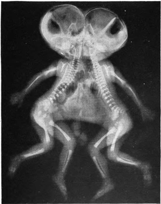 Conjoined twins: Medical condition