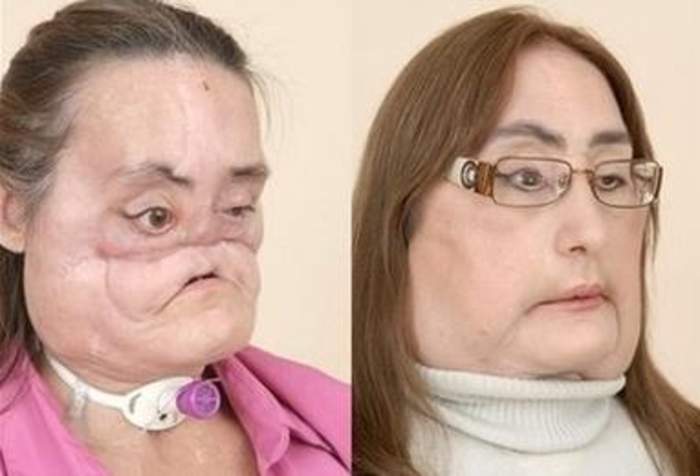 Connie Culp: American face transplant recipient