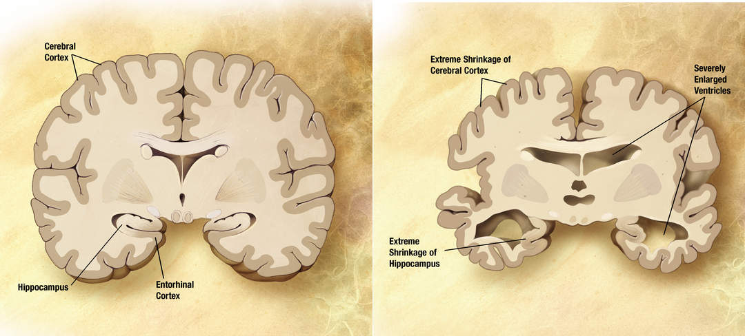 Dementia: Long-term brain disorders causing impaired memory, thinking and behavior