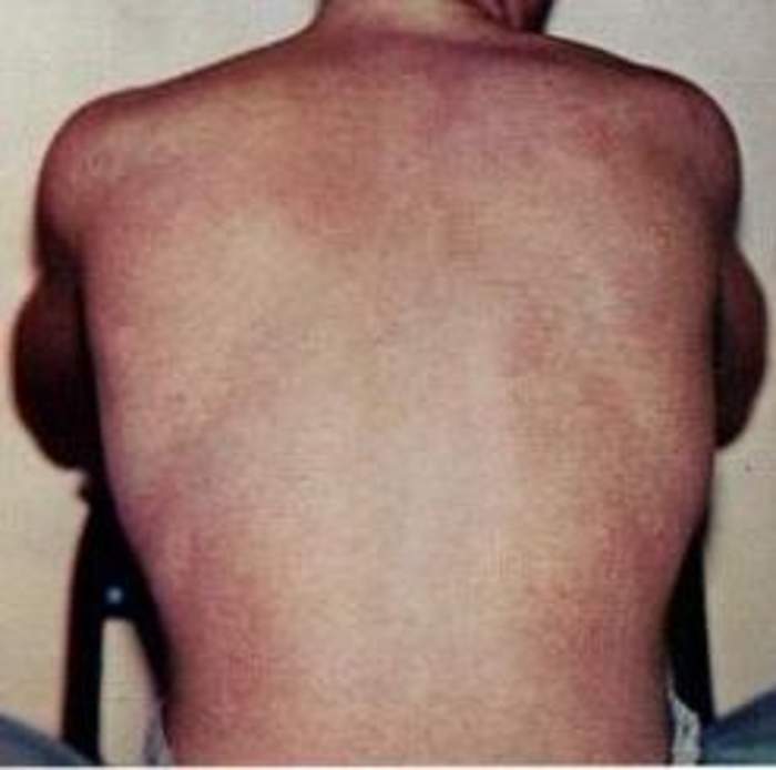 Dengue fever: Mosquito-borne disease
