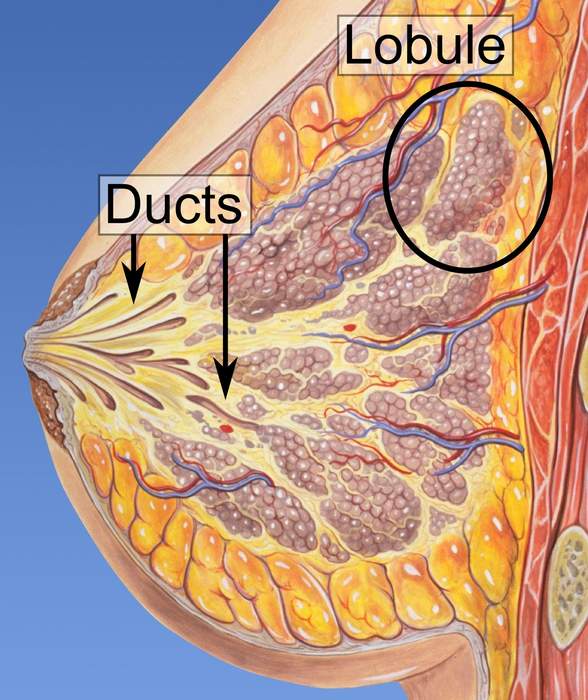 Ductal carcinoma in situ: Pre-cancerous breast lesion