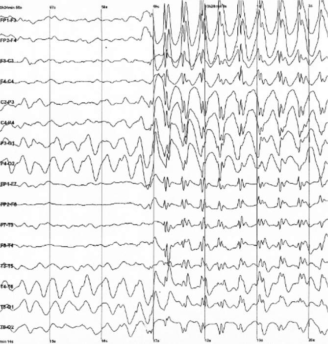 Electroencephalography: Electrophysiological monitoring method to record electrical activity of the brain