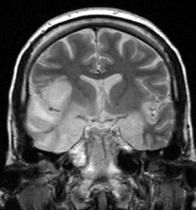 Encephalitis: Brain disease that is characterized as an acute inflammation of the brain with flu-like symptoms