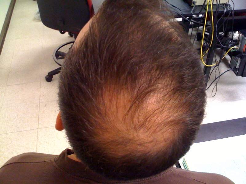 Hair loss: Loss of hair from the head or body