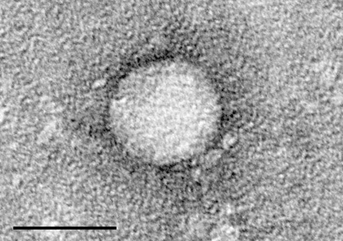Hepatitis C: Human viral infection