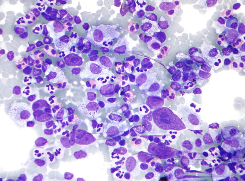 Hodgkin lymphoma: Type of blood and immune-system cancer