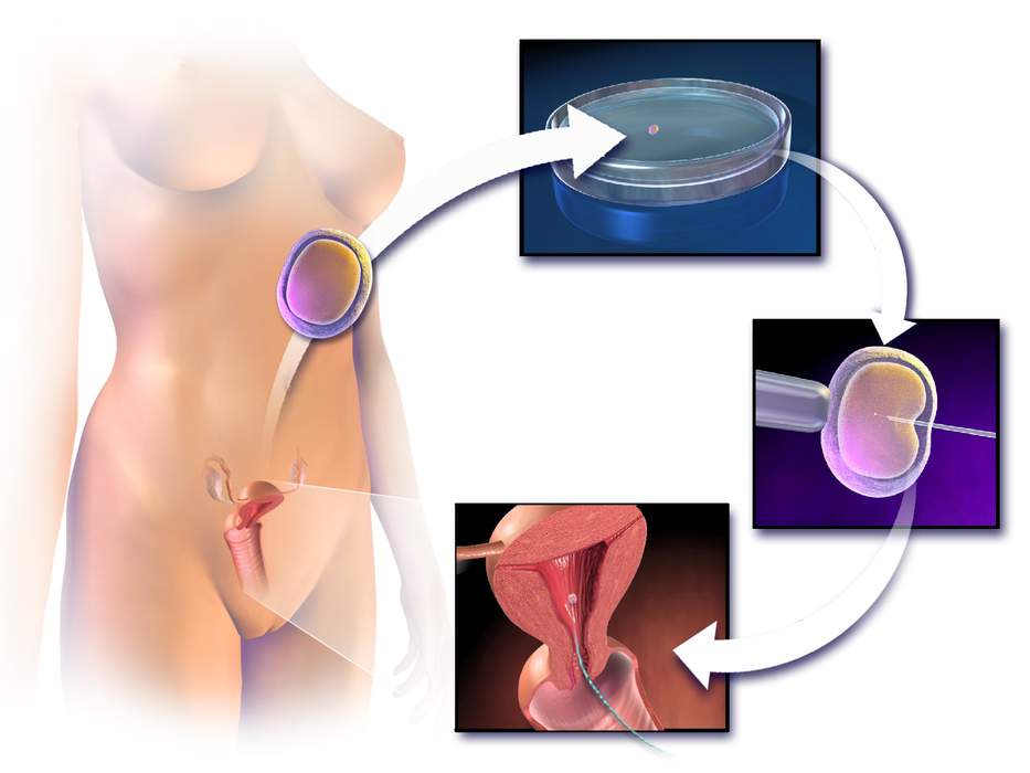 In vitro fertilisation: Assisted reproductive technology procedure