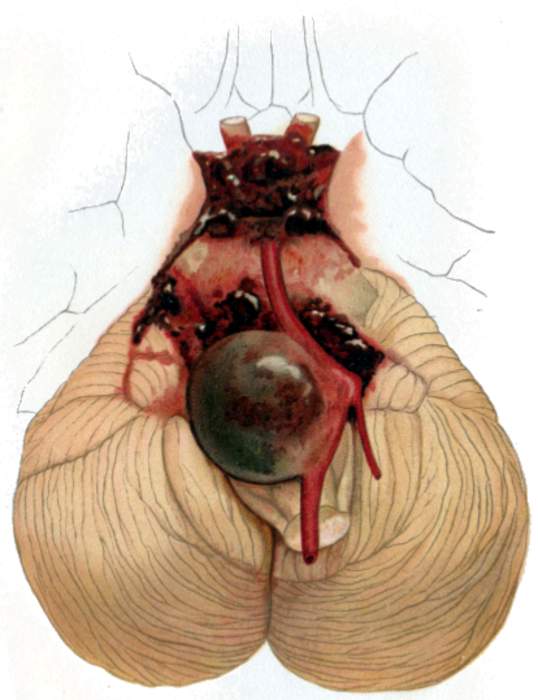 Intracranial aneurysm: Cerebrovascular disorder