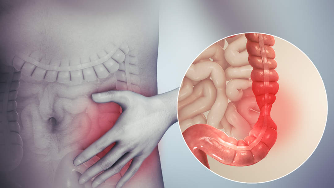 Irritable bowel syndrome: Functional gastrointestinal disorder