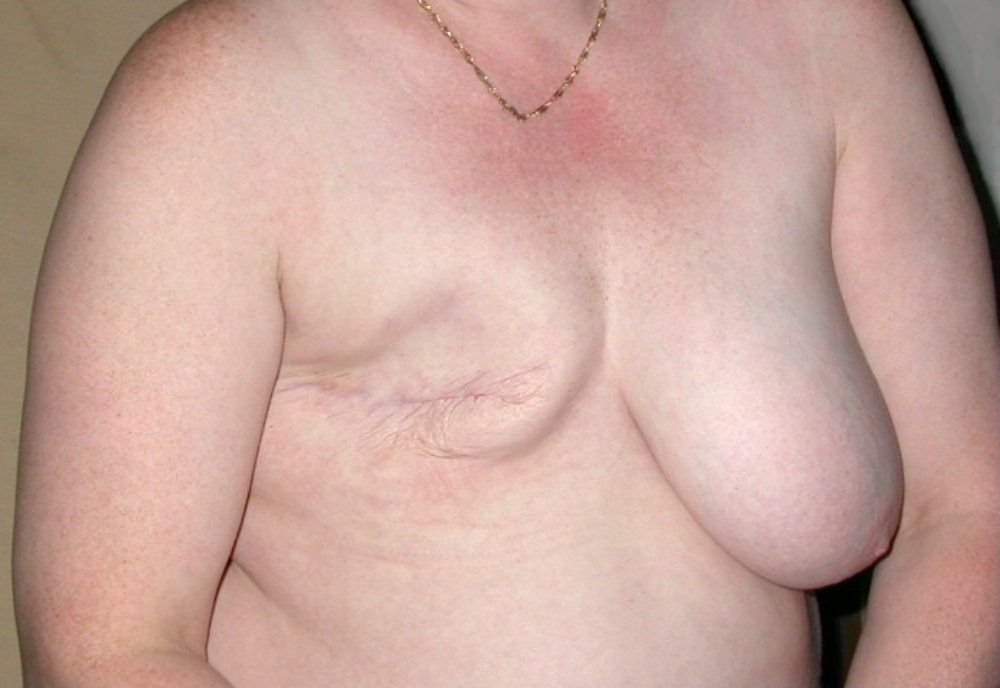 Mastectomy: Surgical removal of one or both breasts