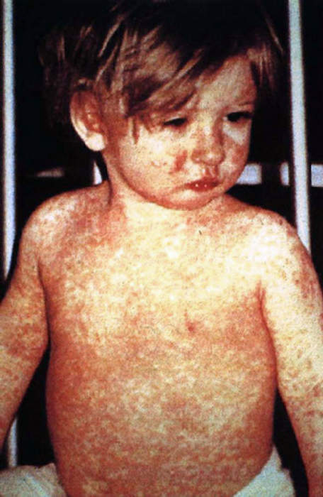 Measles: Viral disease affecting humans