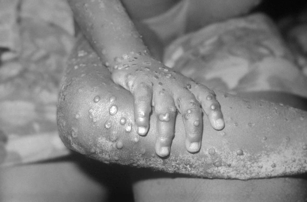 Monkeypox: Infectious disease caused by the monkeypox virus that can occur in certain animals including humans