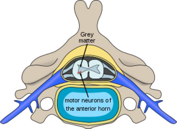 Motor neuron diseases: Group of neurological disorders affecting motor neurons