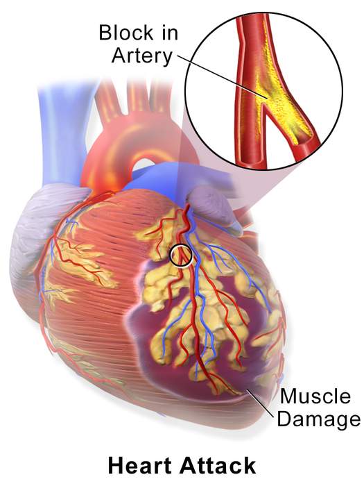 Myocardial infarction: Interruption of blood supply to a part of the heart