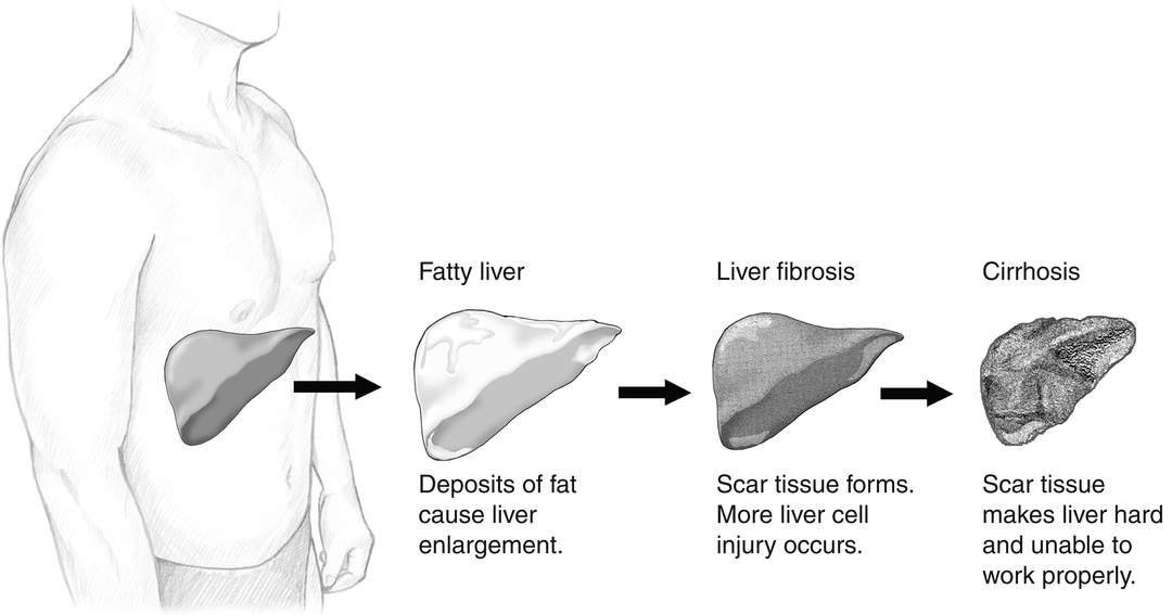 Non-alcoholic fatty liver disease: Excessive fat build-up in the liver not caused by alcohol use
