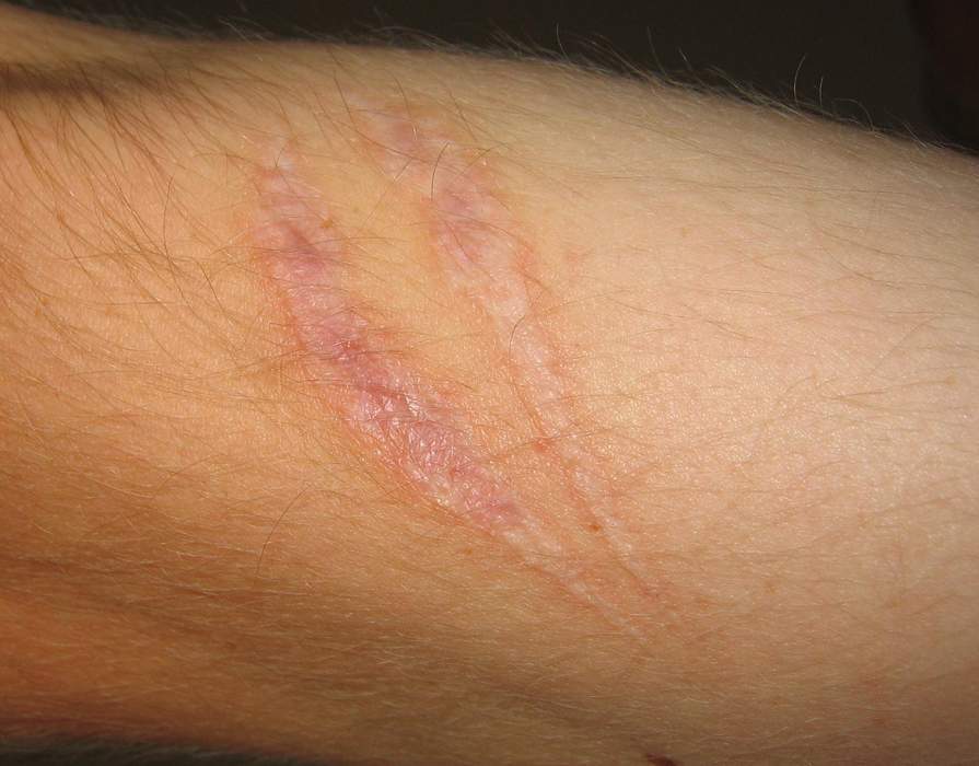 Scar: Area of fibrous tissue that replaces normal skin after an injury