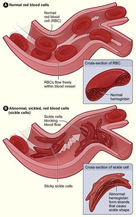 Sickle cell disease: Group of genetic blood disorders
