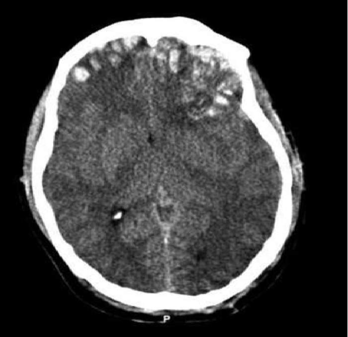 Traumatic brain injury: Injury of the brain from an external source
