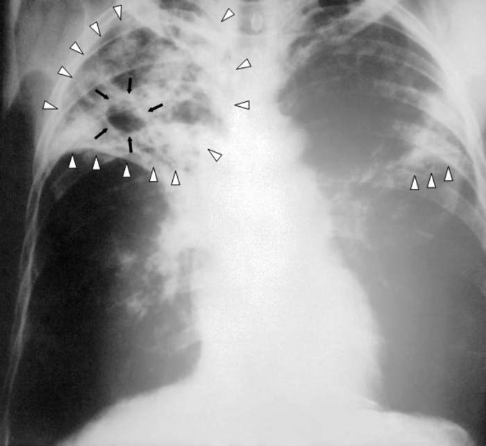 Tuberculosis: Infectious disease